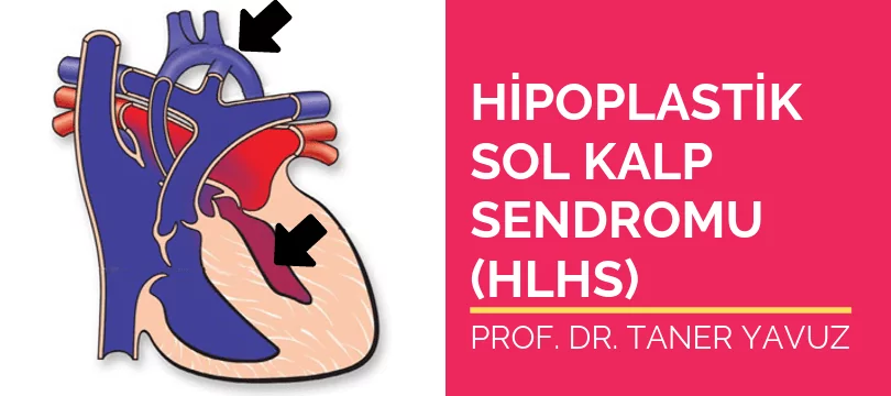 Hipoplastik sol kalp sendromu HLHS