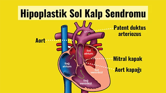 Hipoplastik sol kalp sendromu